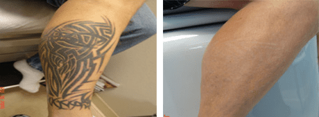 Before and After Laser Tattoo Removal
