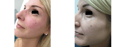 Before and After Facial Capillaries Treatment