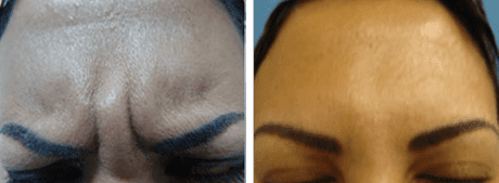 botox procedure before and after