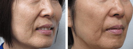 skin resurfacing before and after