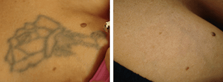 tattoo removal before and after