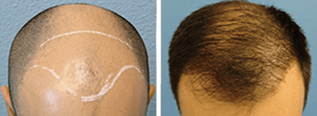hair transplant before and after