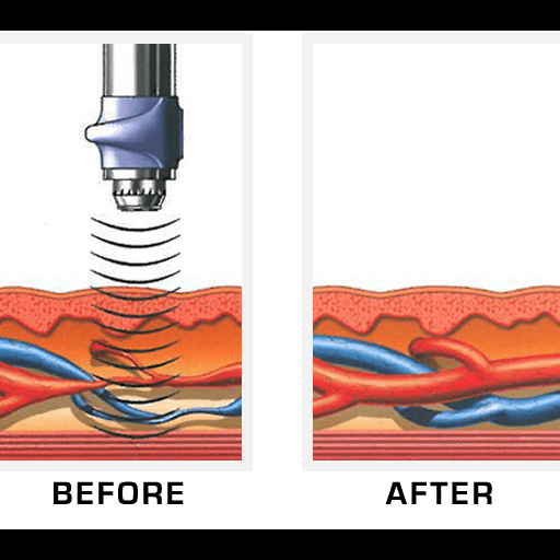 Femiwave before and after effects on skin